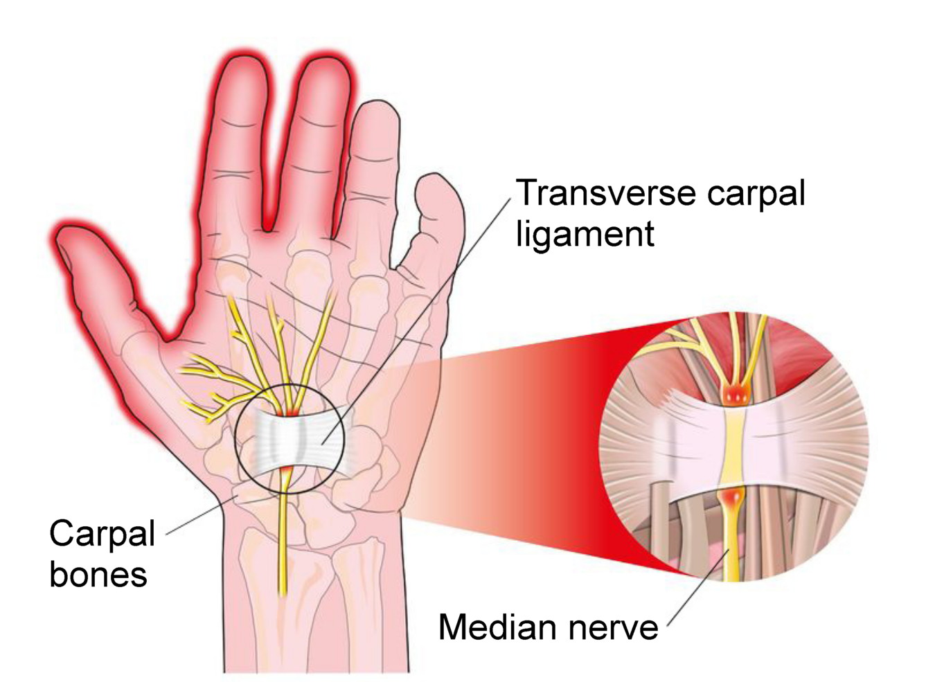 Carpal tunnel syndrome