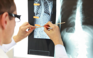 idiopathic scoliosis