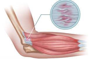 tendinosis