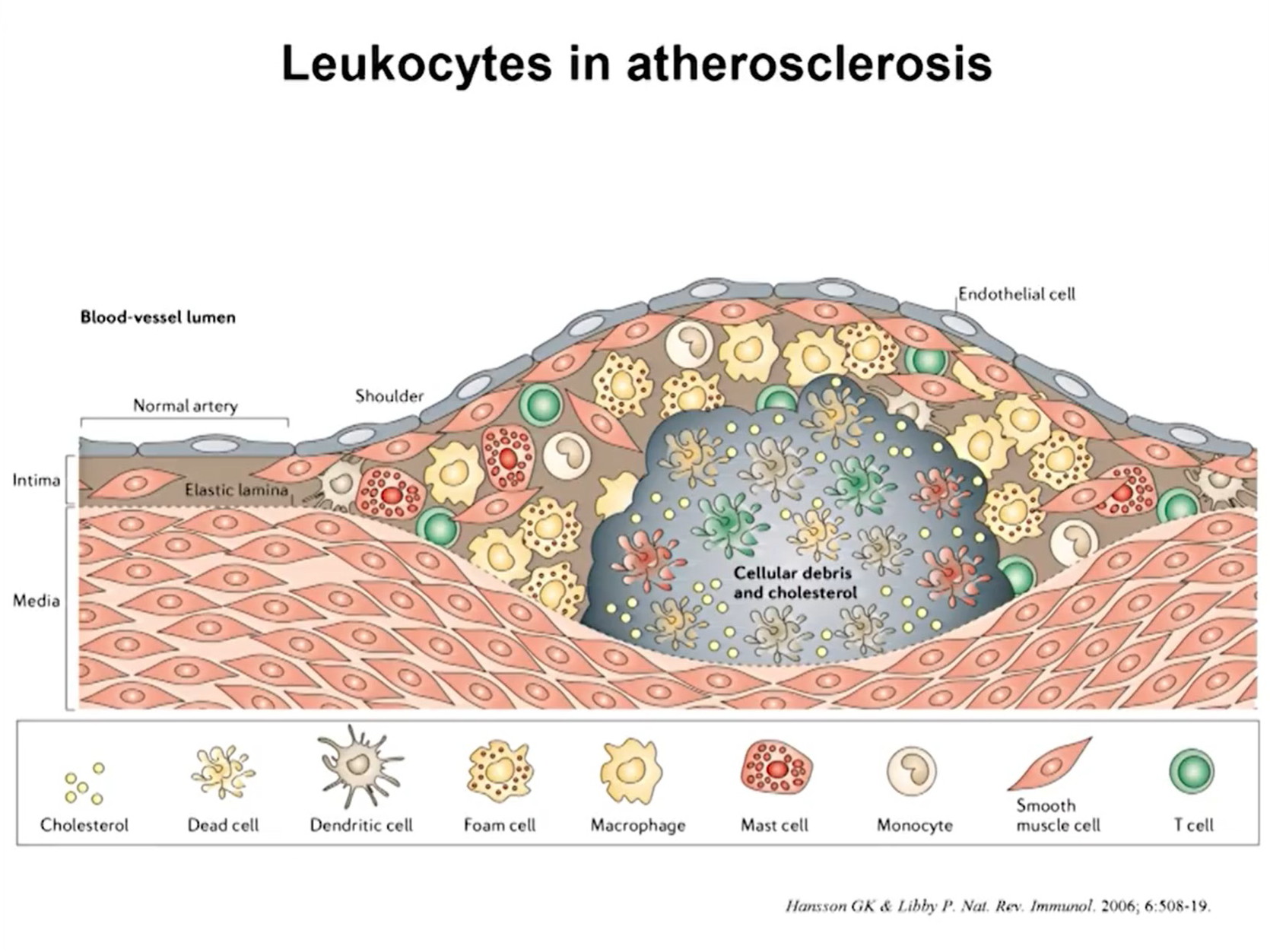 Atherosclerosis