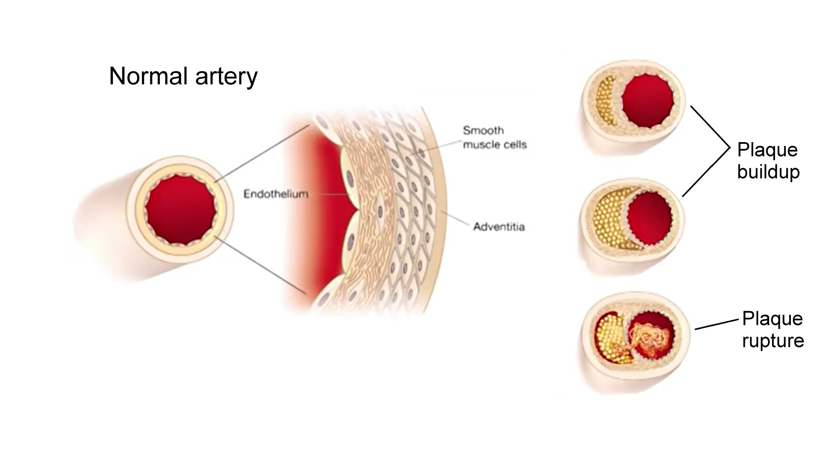 Atherosclerosis