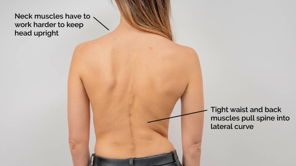 Scoliosis tight muscles