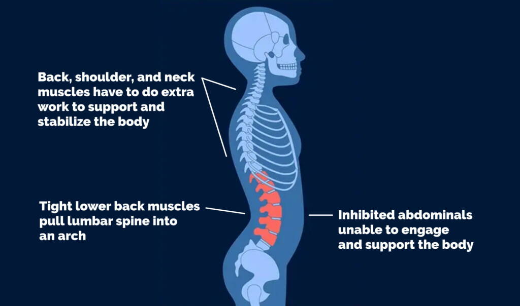 Hyperlordosis
