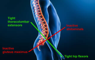 Lower cross syndrome