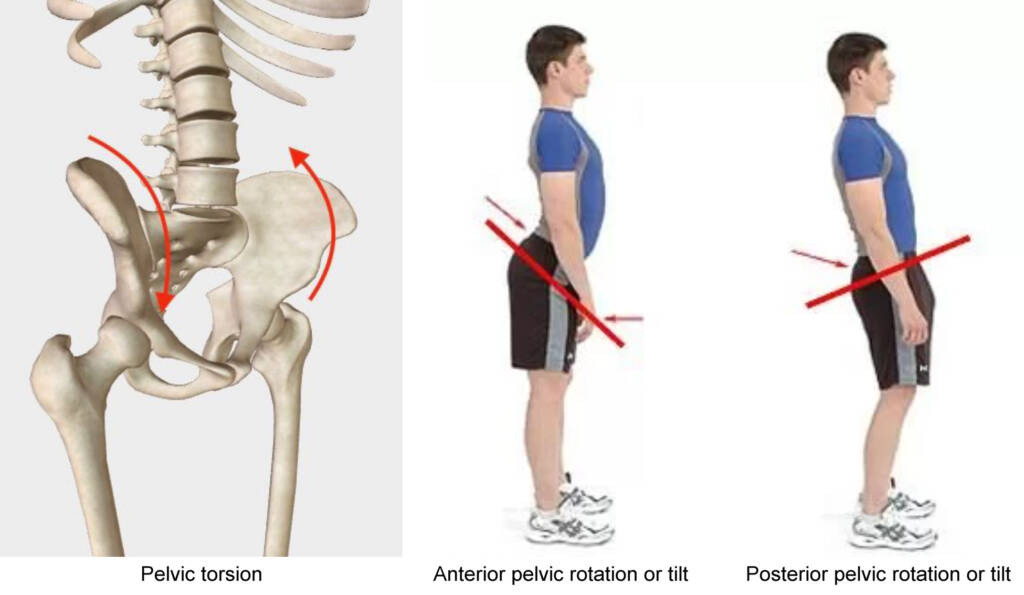 Pelvic torsion