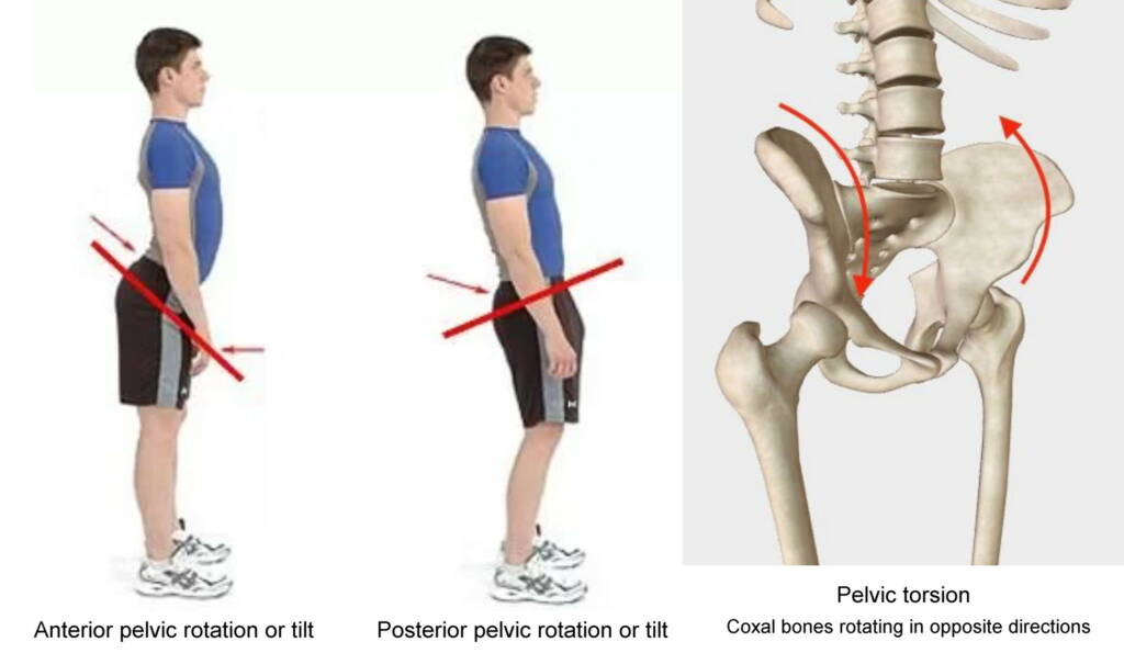 Pelvic torsion Twisted pelvis