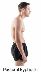 Postural kyphosis
