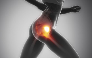 snapping hip syndrome