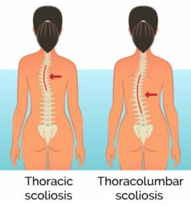 Thoracic scoliosis