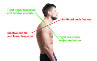 Upper crossed syndrome